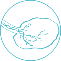 Ovarian cancer